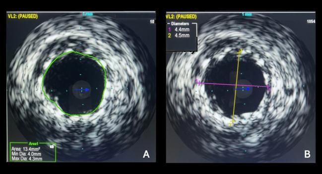 Intravascular Imaging Lowers Risk of MACE at 1 Year in Left Main PCI